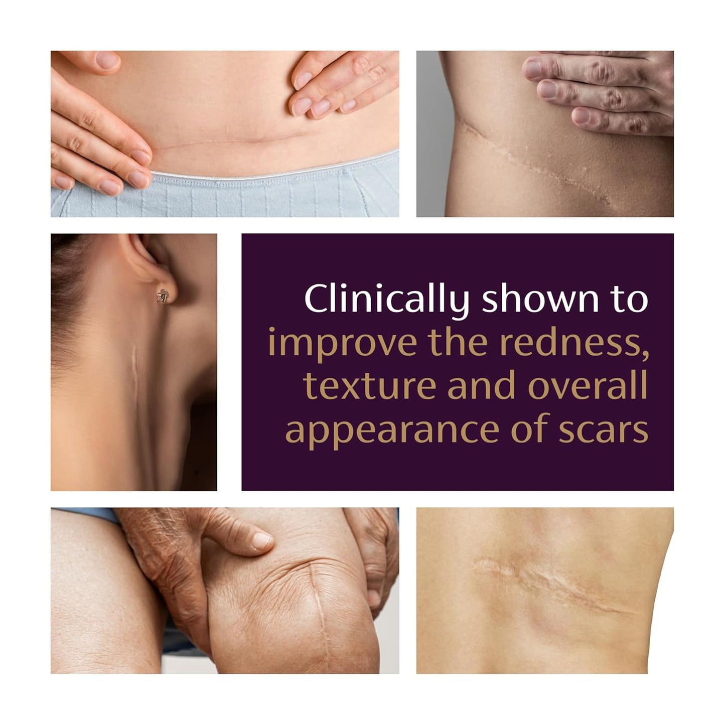 Mederma® Advanced Scar Gel